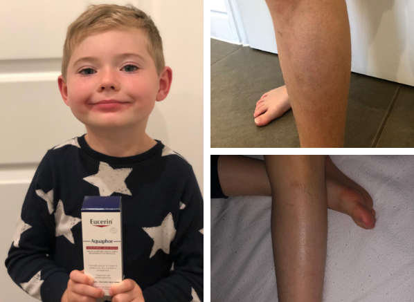 how to use eucerin aquaphor on children with dry legs