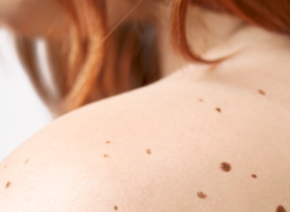How To Check Your Moles At Home