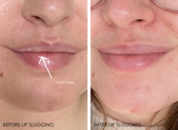 Lip slugging to soothe dry, flaky lips