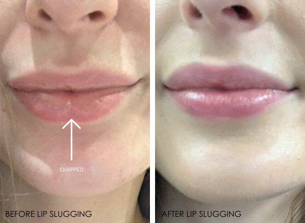 lip slugging for chapped lips